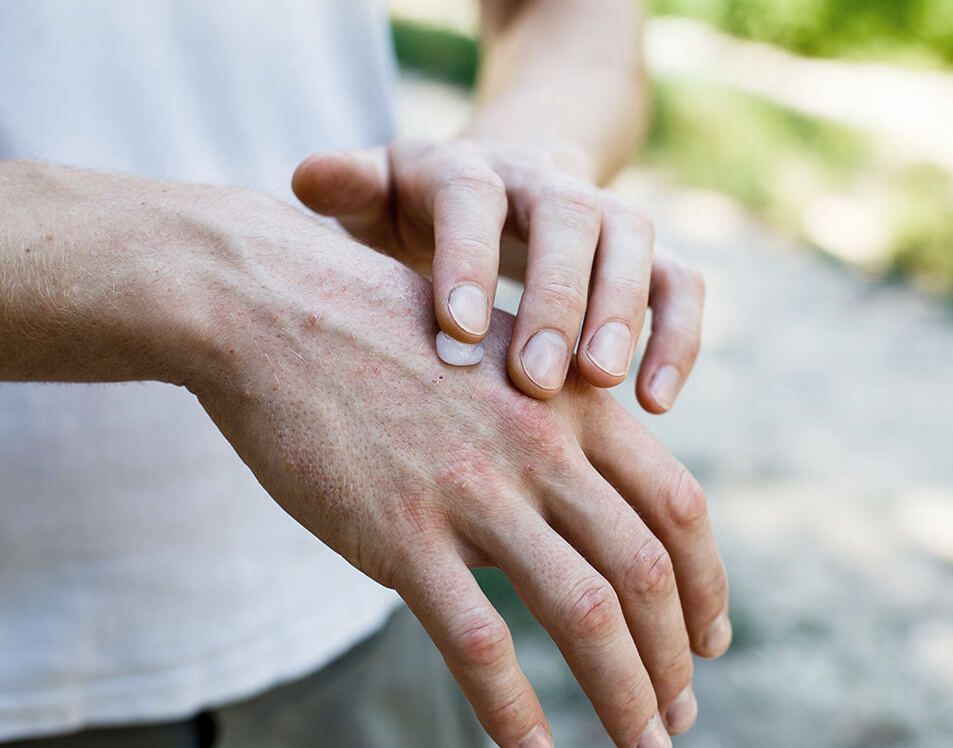 Applying cream on the hand with psoriasis