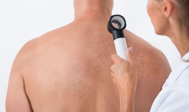 A dermatologist examining acne scar on a patient's back.