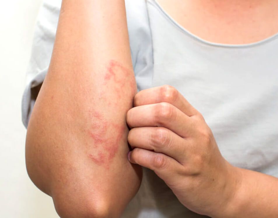 Eczema on arms