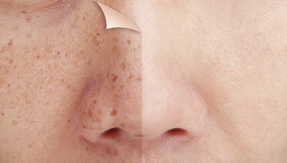 Laser pigmentation removal on nose