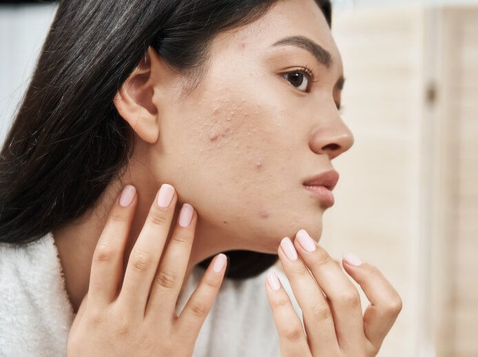 Woman examining her skin with acne in the mirror