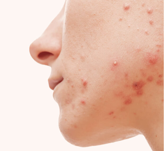 Face With Acne