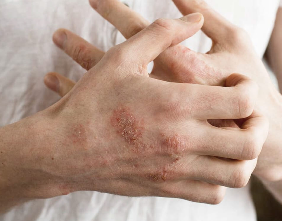 Itchy hands with eczema