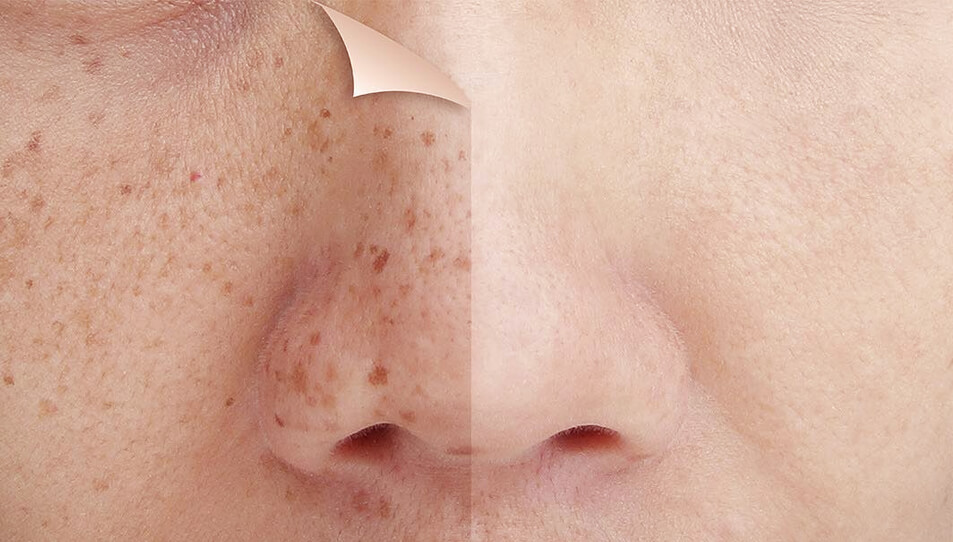 Laser pigmentation removal on nose