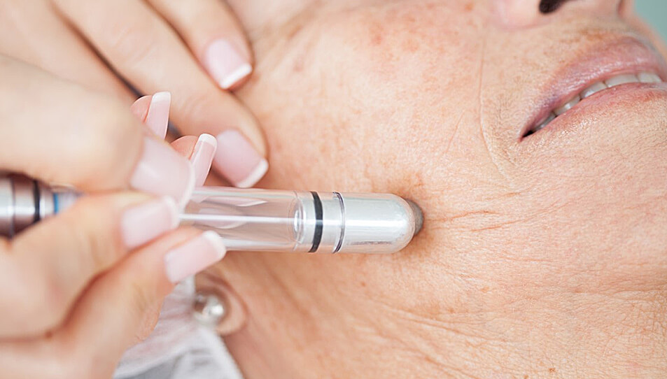 Woman having smoothbeam laser